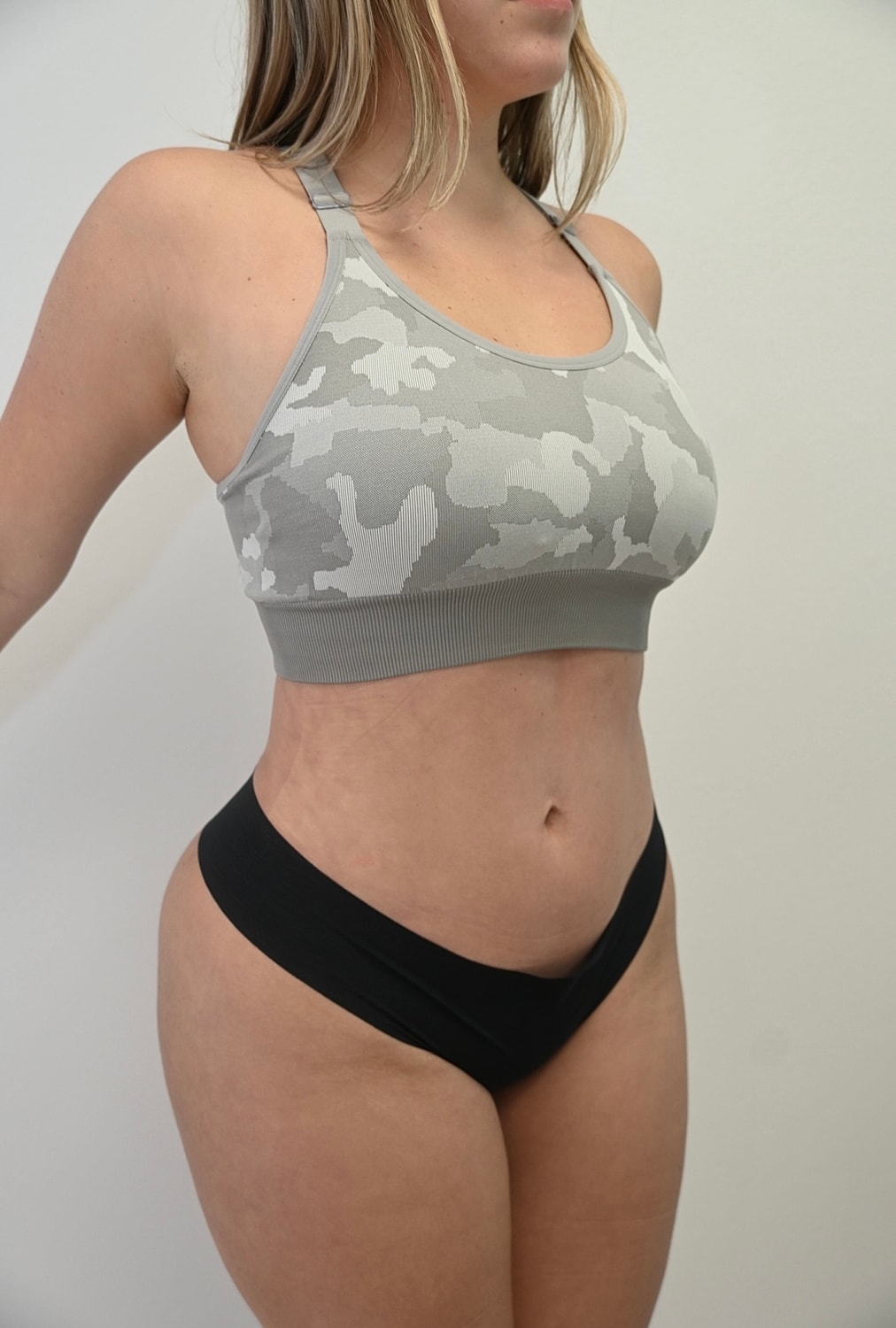 Liposuccion Abdomen Before & After