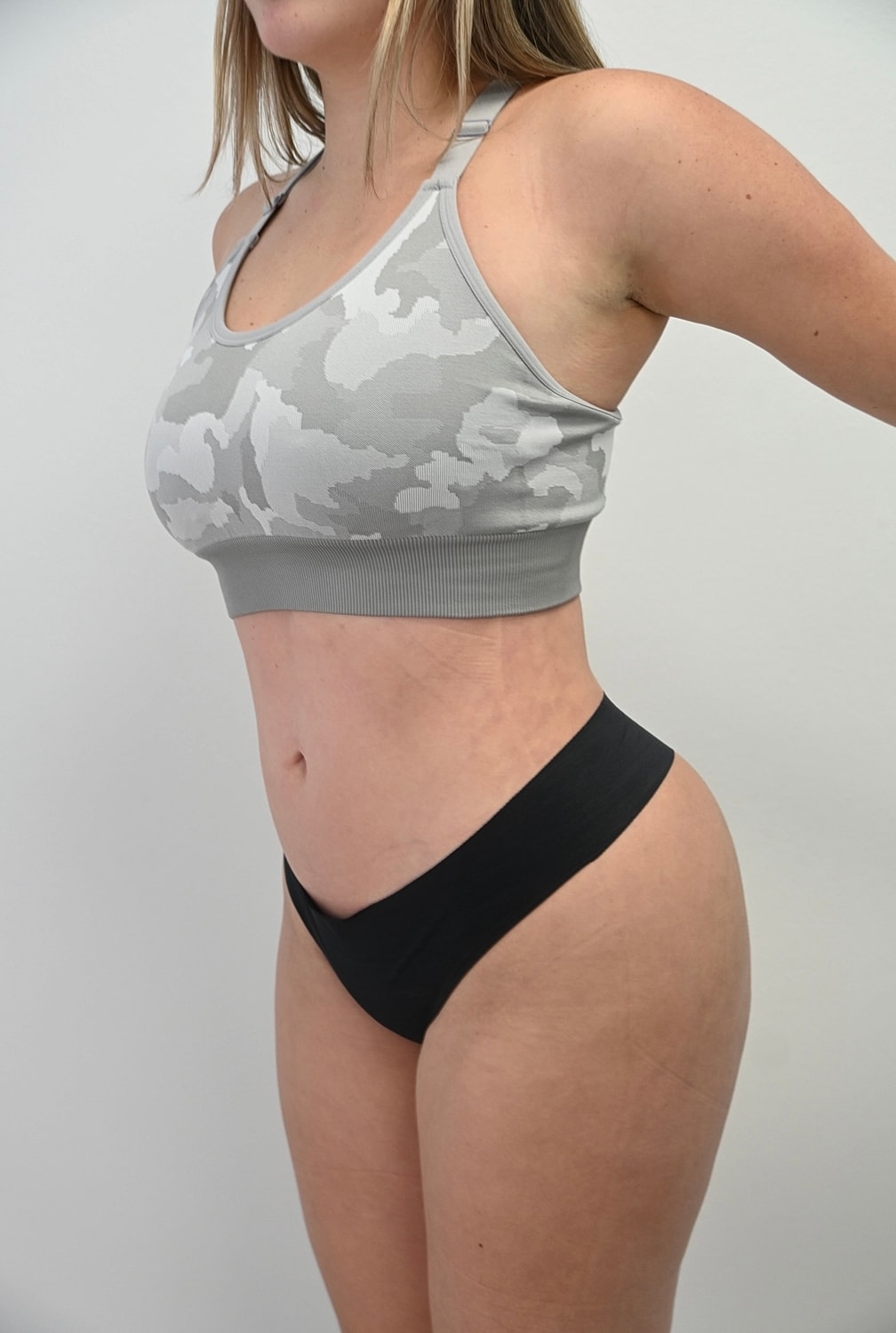 Liposuccion Abdomen Before & After