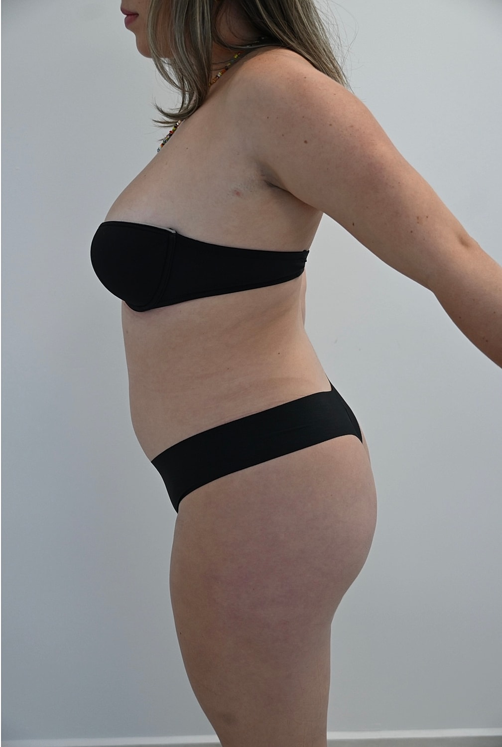 Liposuccion Abdomen Before & After