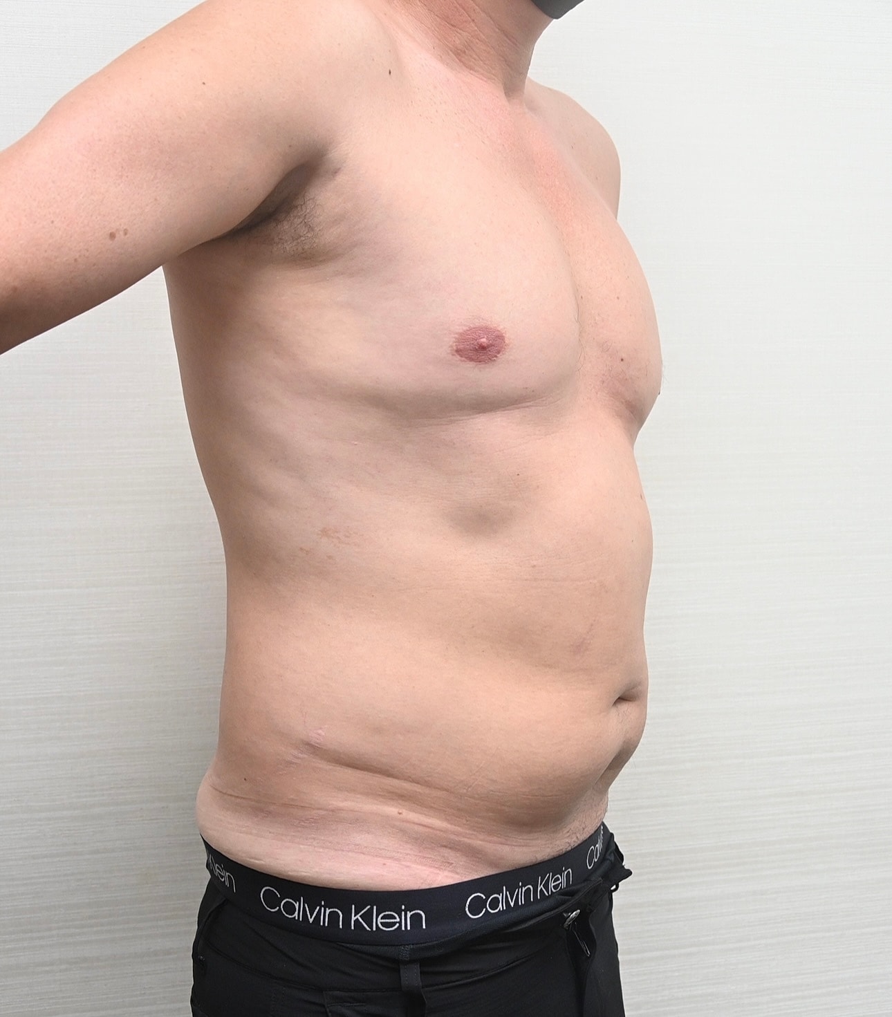 Liposuccion Abdomen Before & After