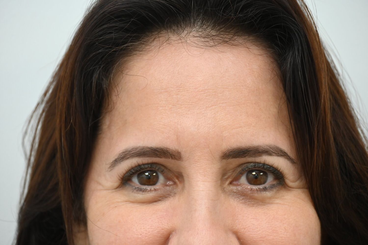 Blefaroplastia Before & After