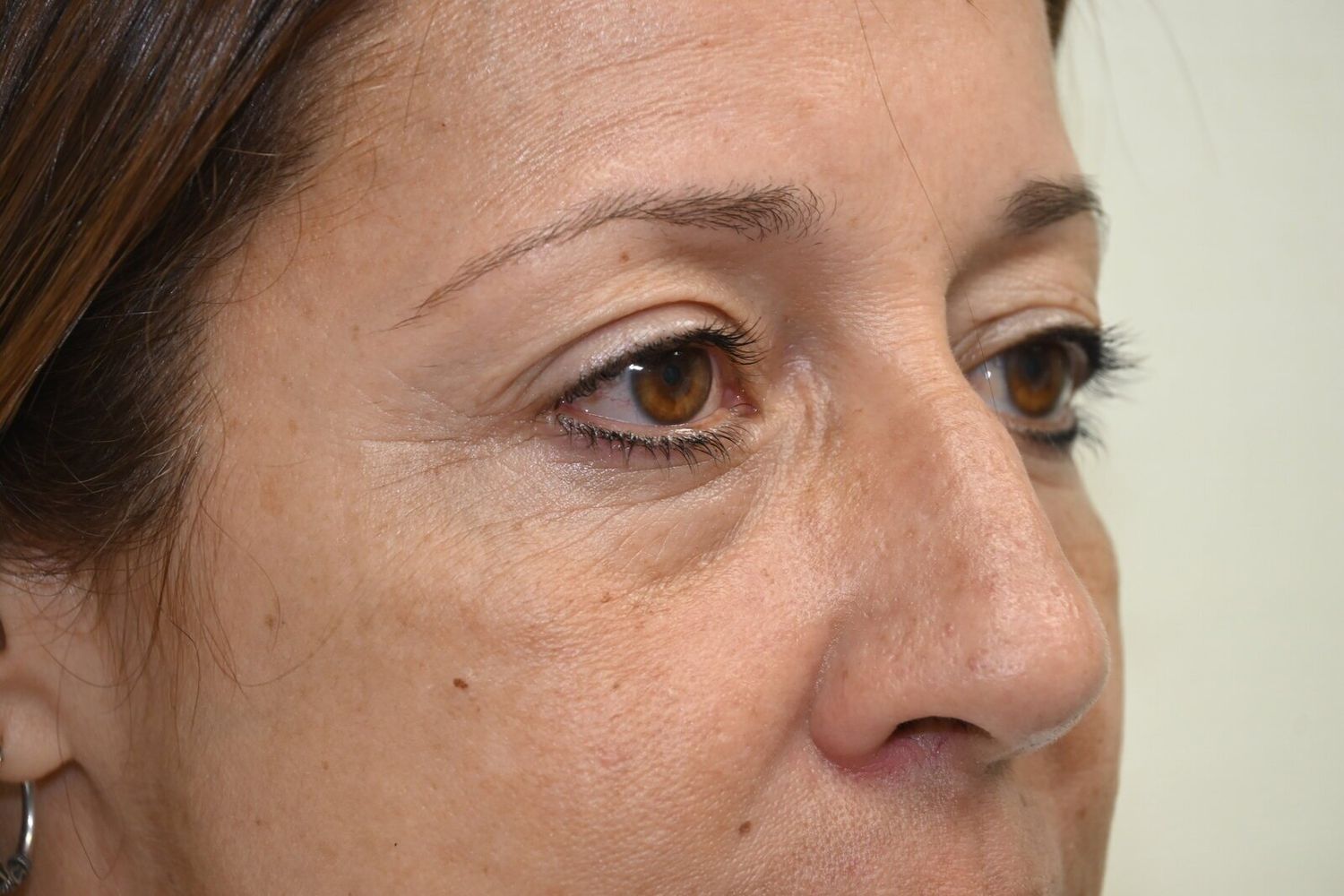 Blefaroplastia Before & After