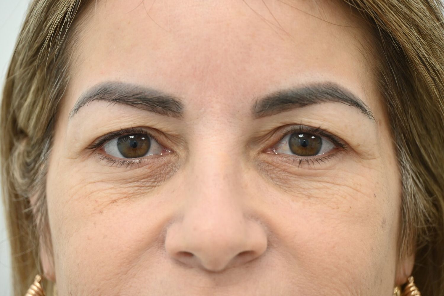 Blefaroplastia Before & After