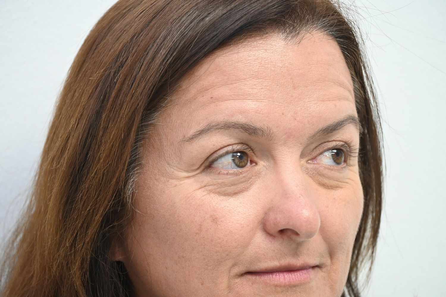 Blefaroplastia Before & After