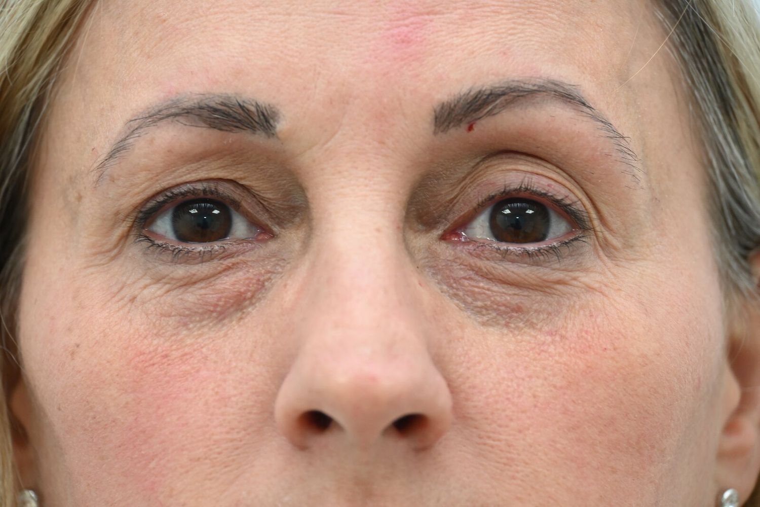 Blefaroplastia Before & After