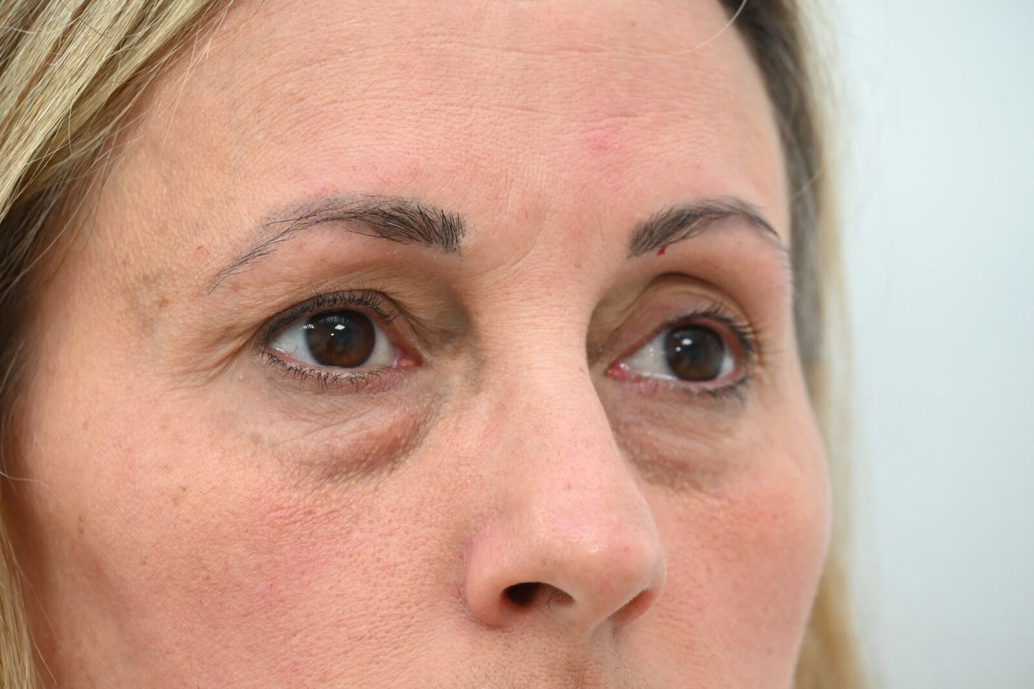 Blefaroplastia Before & After