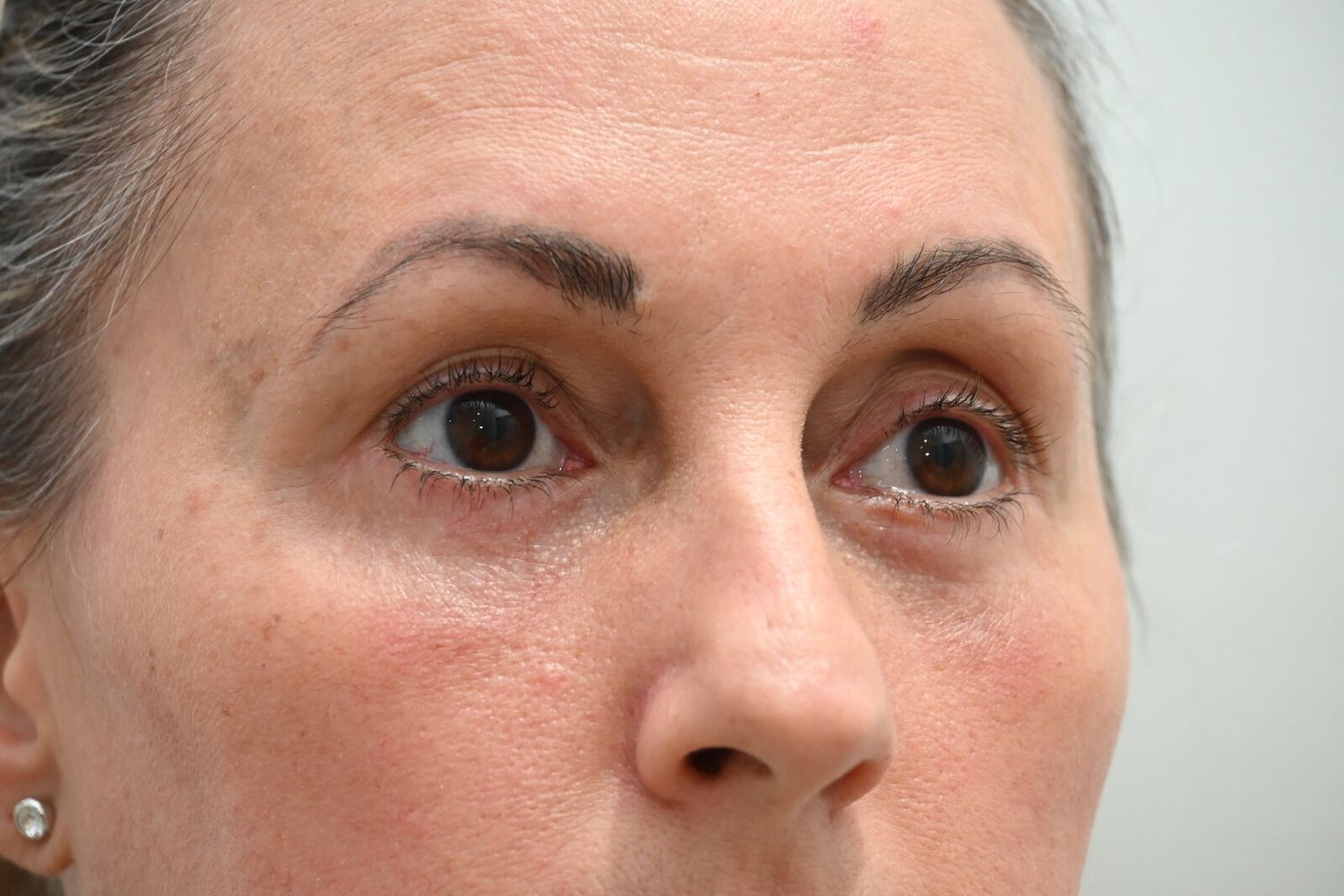 Blefaroplastia Before & After