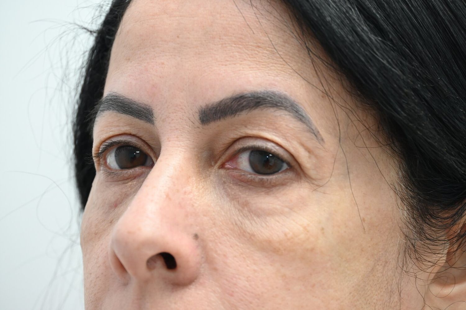 Blefaroplastia Before & After