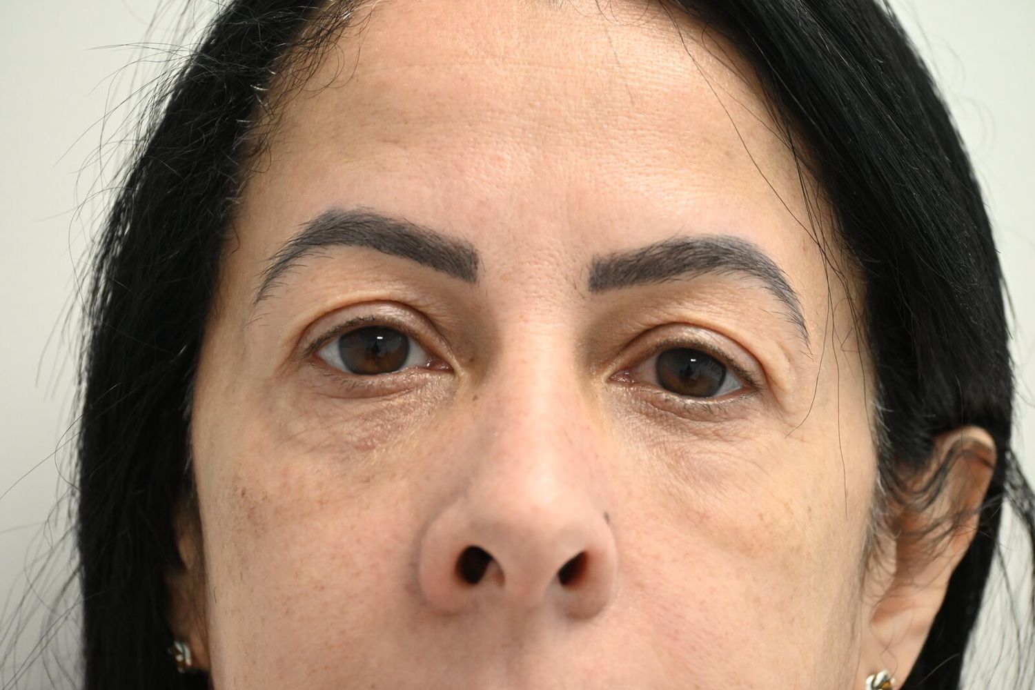 Blefaroplastia Before & After