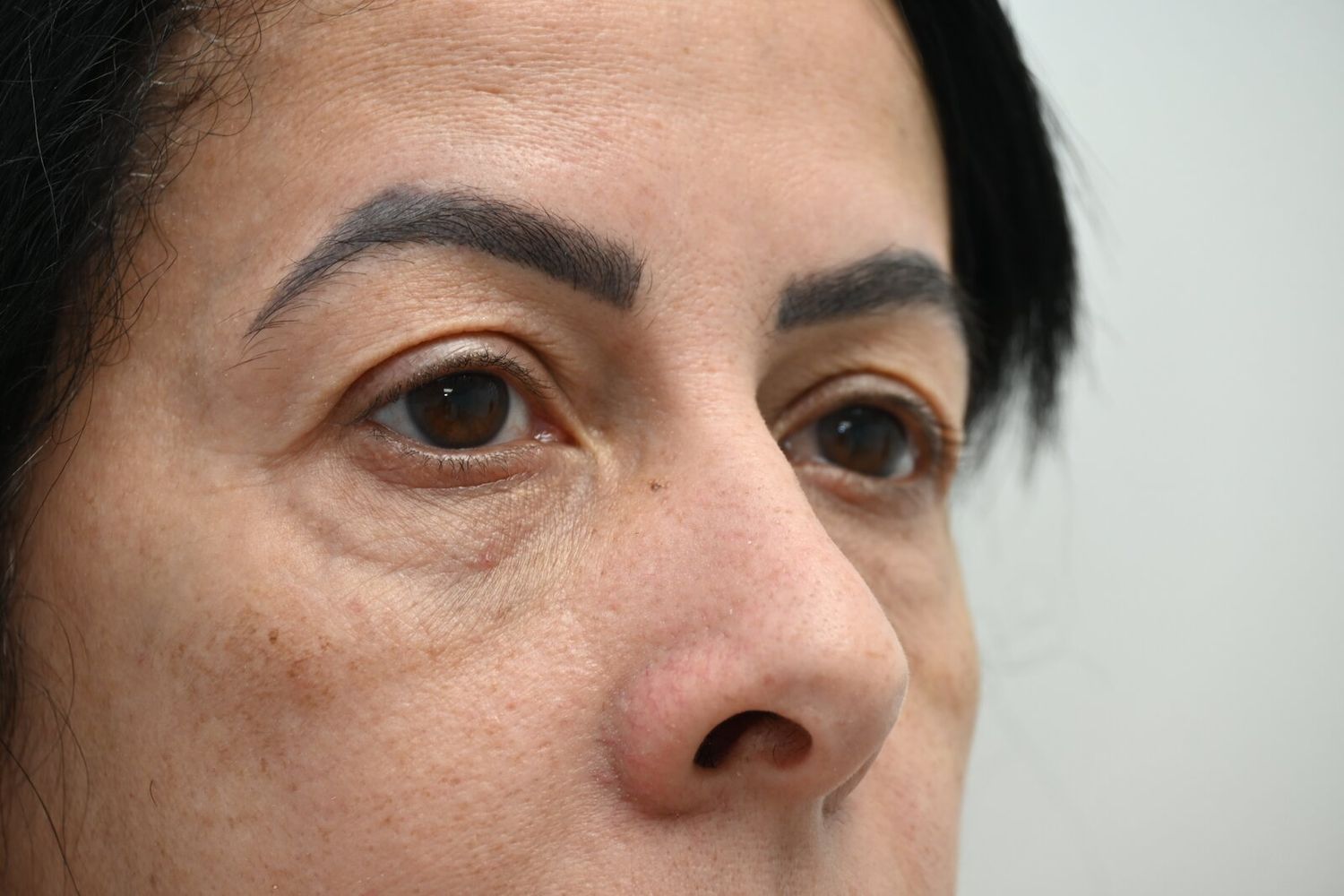 Blefaroplastia Before & After