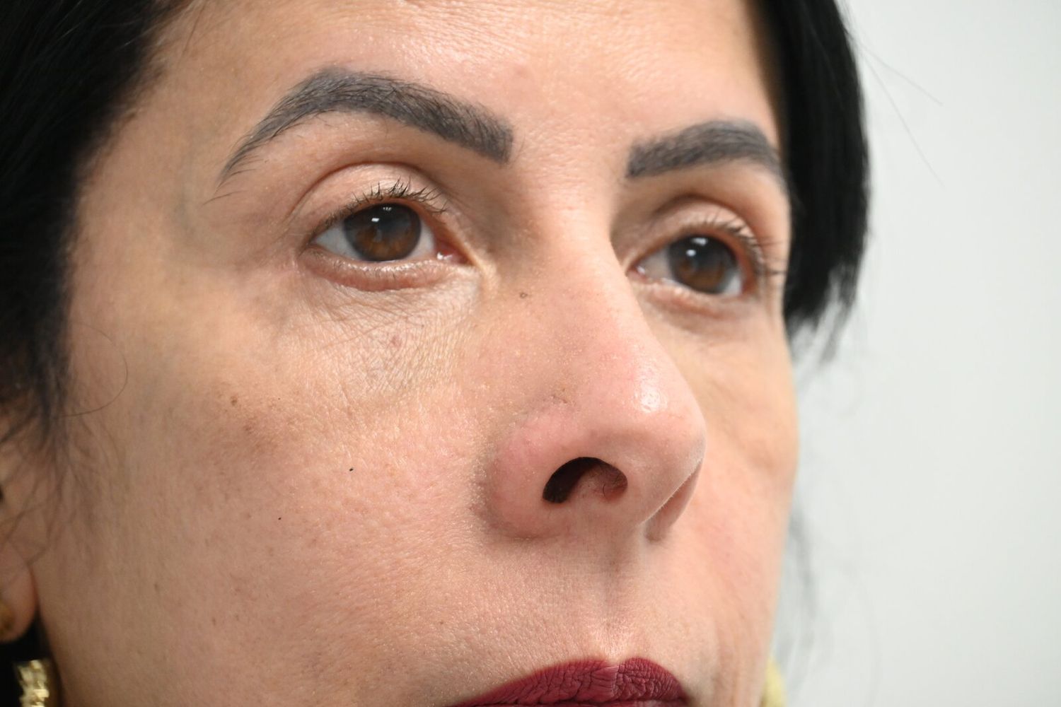 Blefaroplastia Before & After