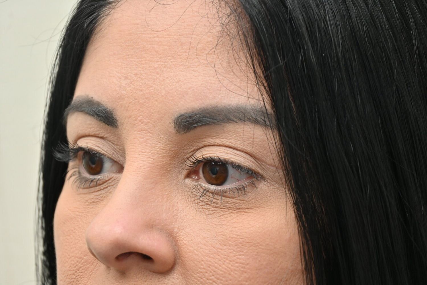 Blefaroplastia Before & After