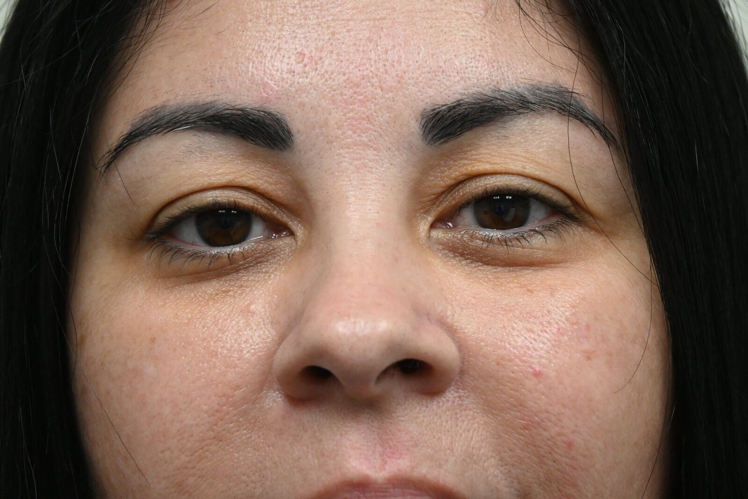 Blefaroplastia Before & After