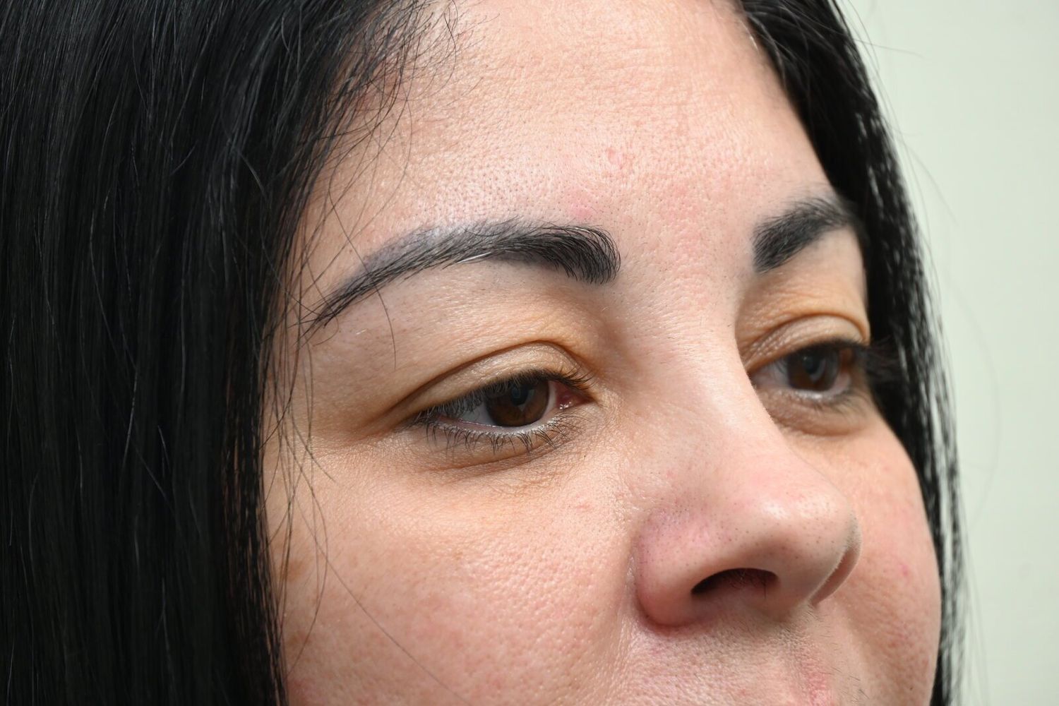 Blefaroplastia Before & After