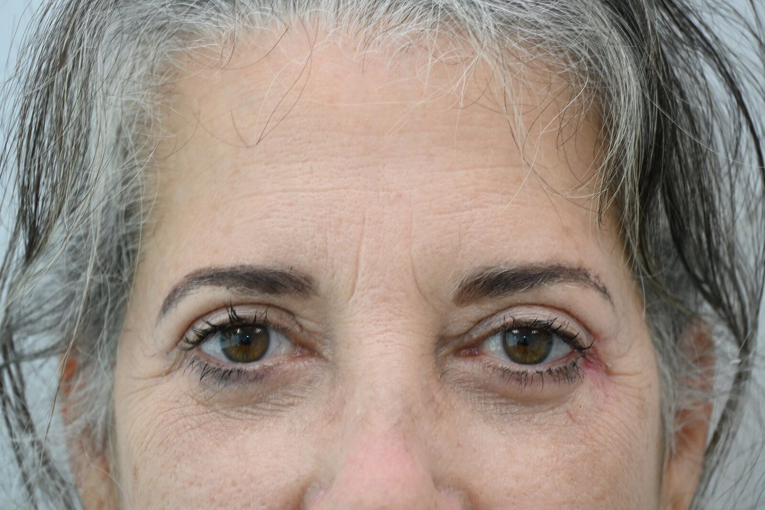 Blefaroplastia Before & After