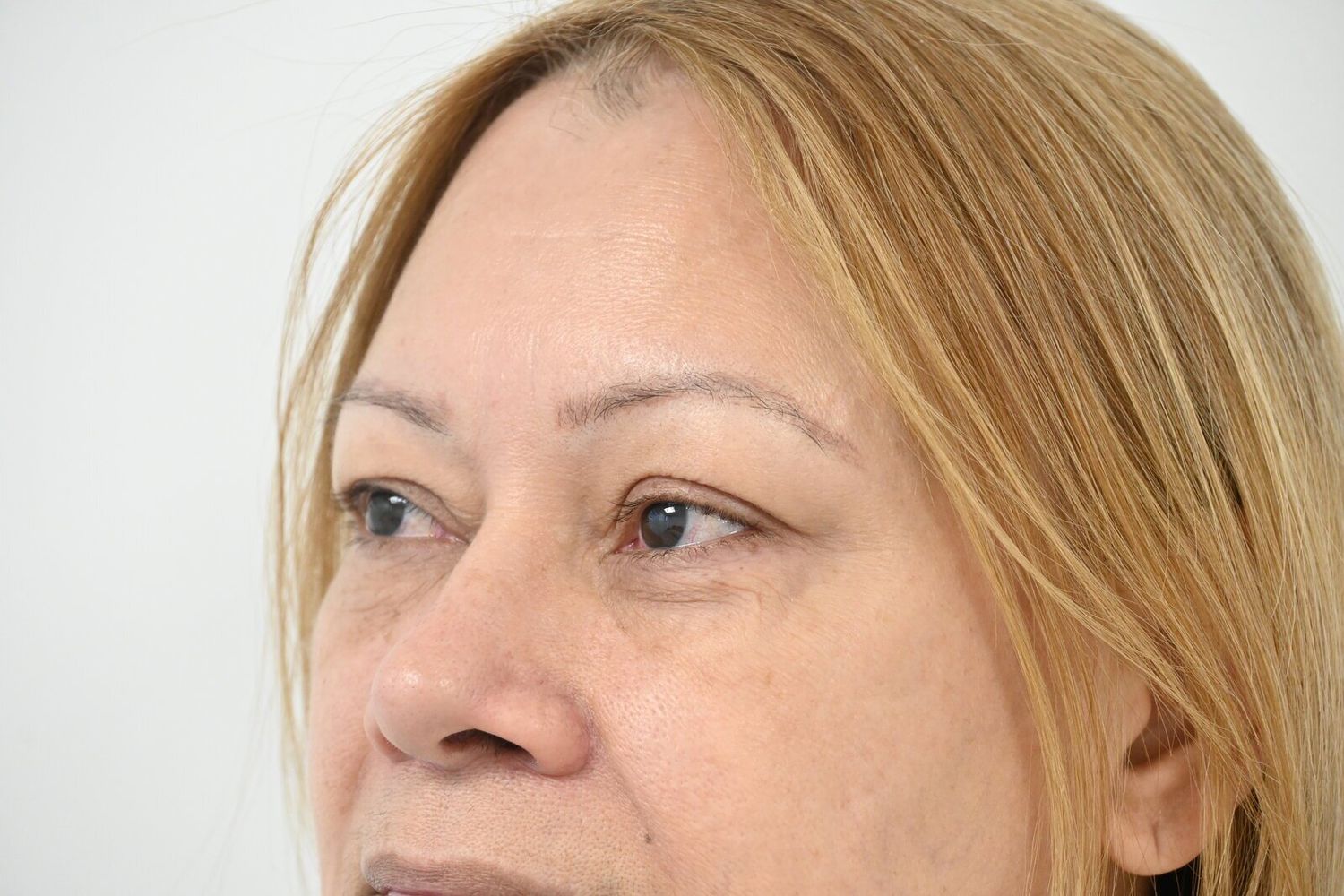 Blefaroplastia Before & After