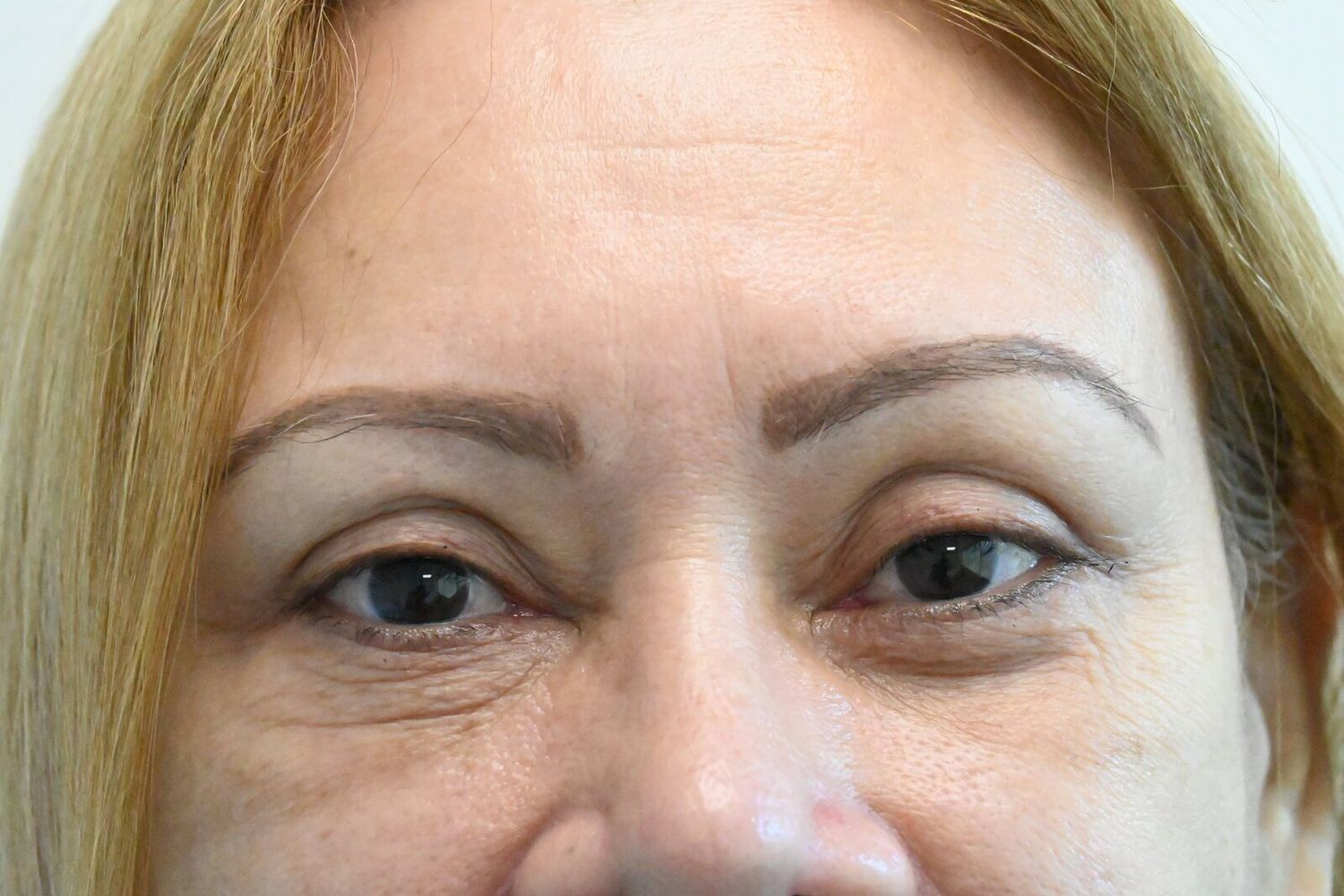 Blefaroplastia Before & After