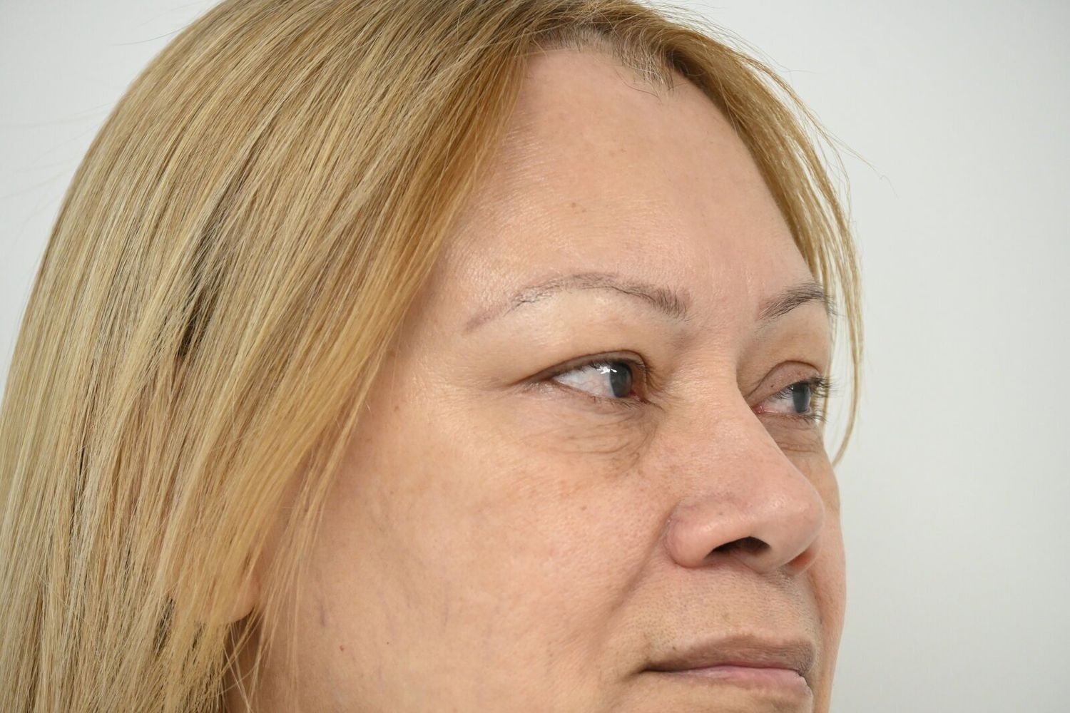 Blefaroplastia Before & After