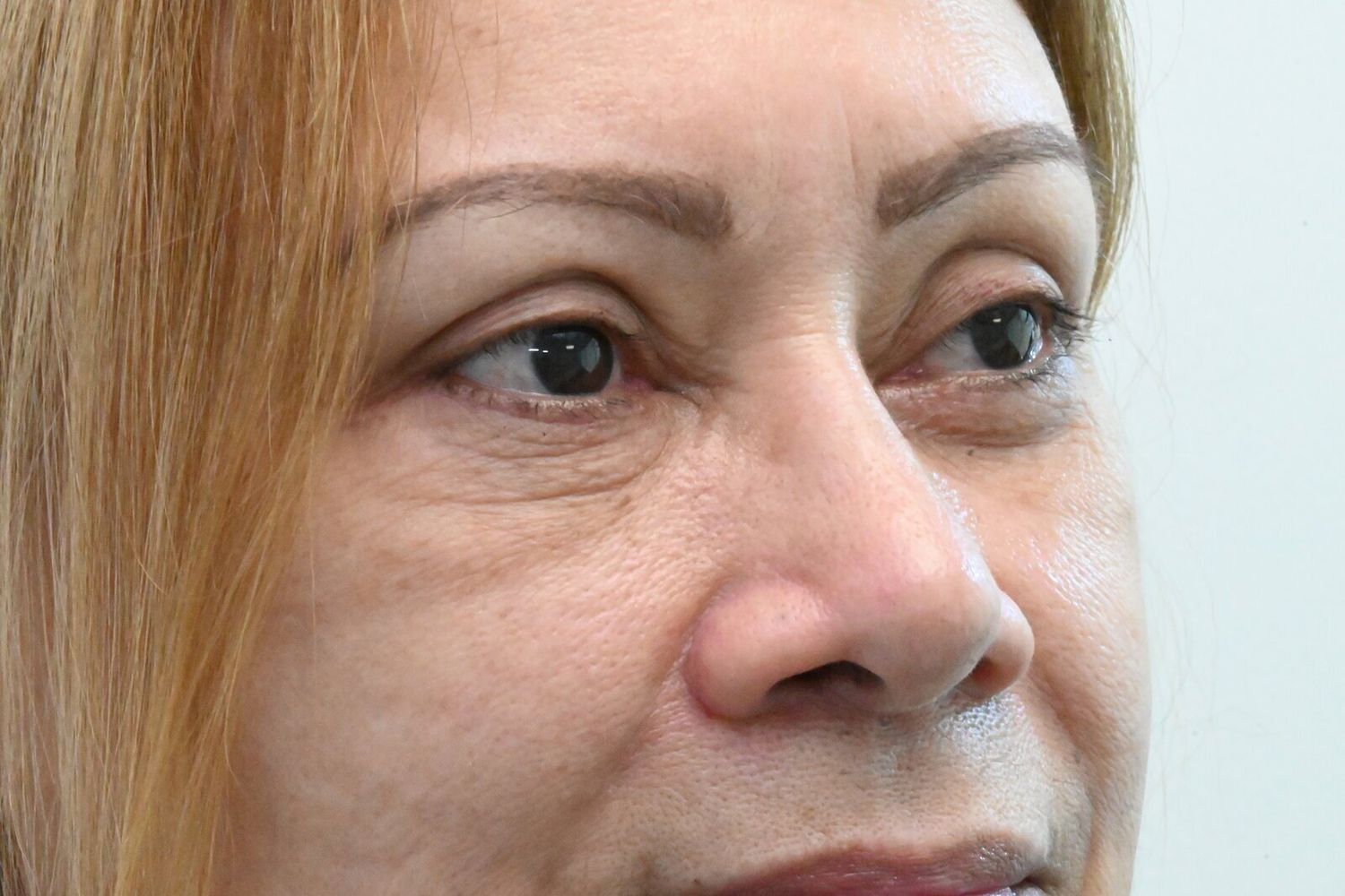 Blefaroplastia Before & After