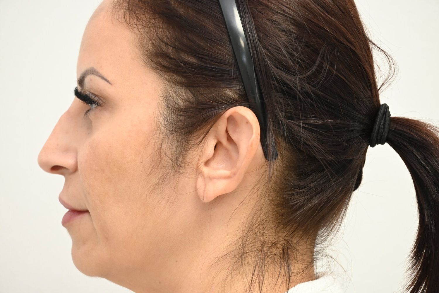 Otoplastia Before & After