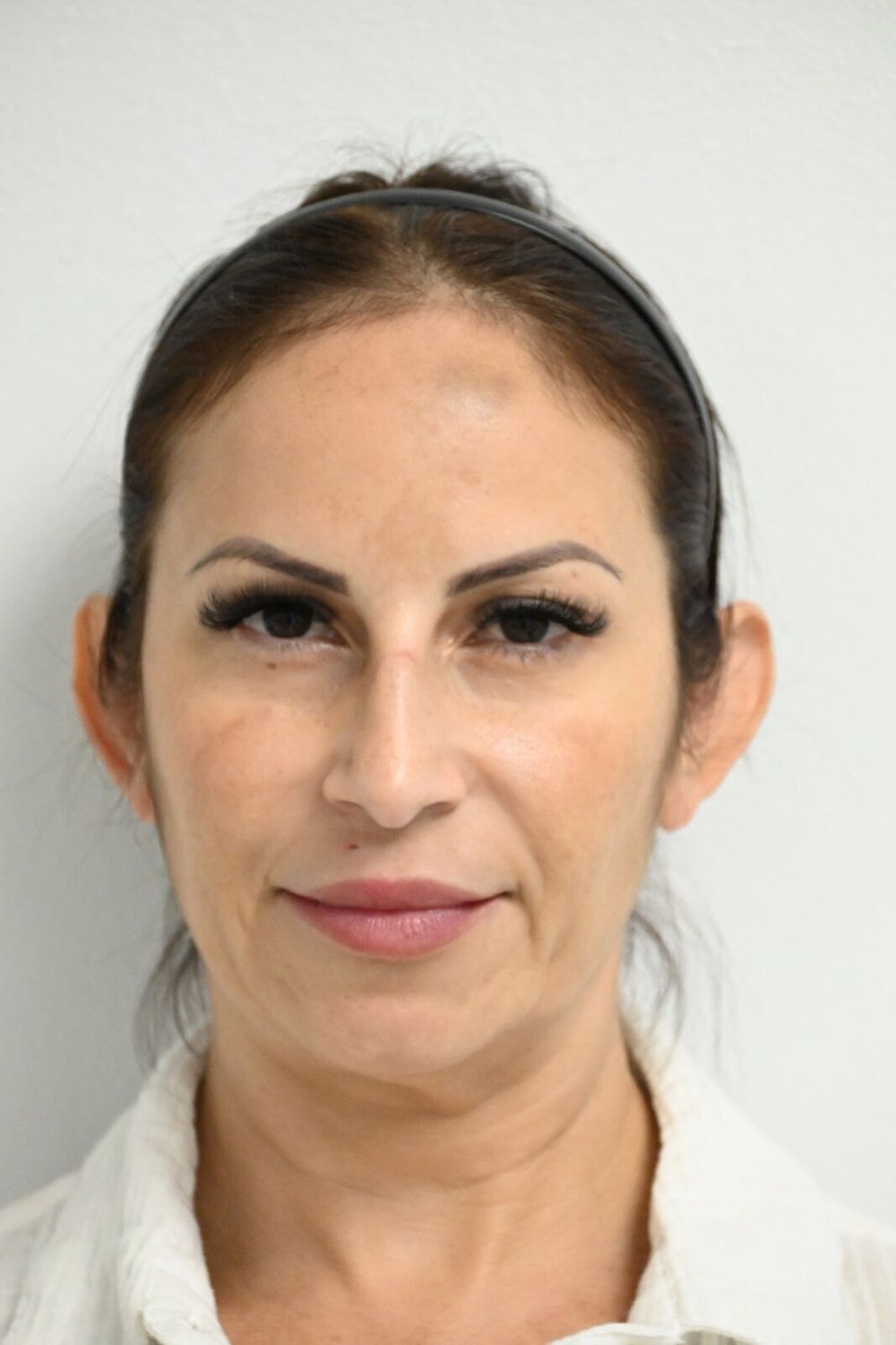 Otoplastia Before & After