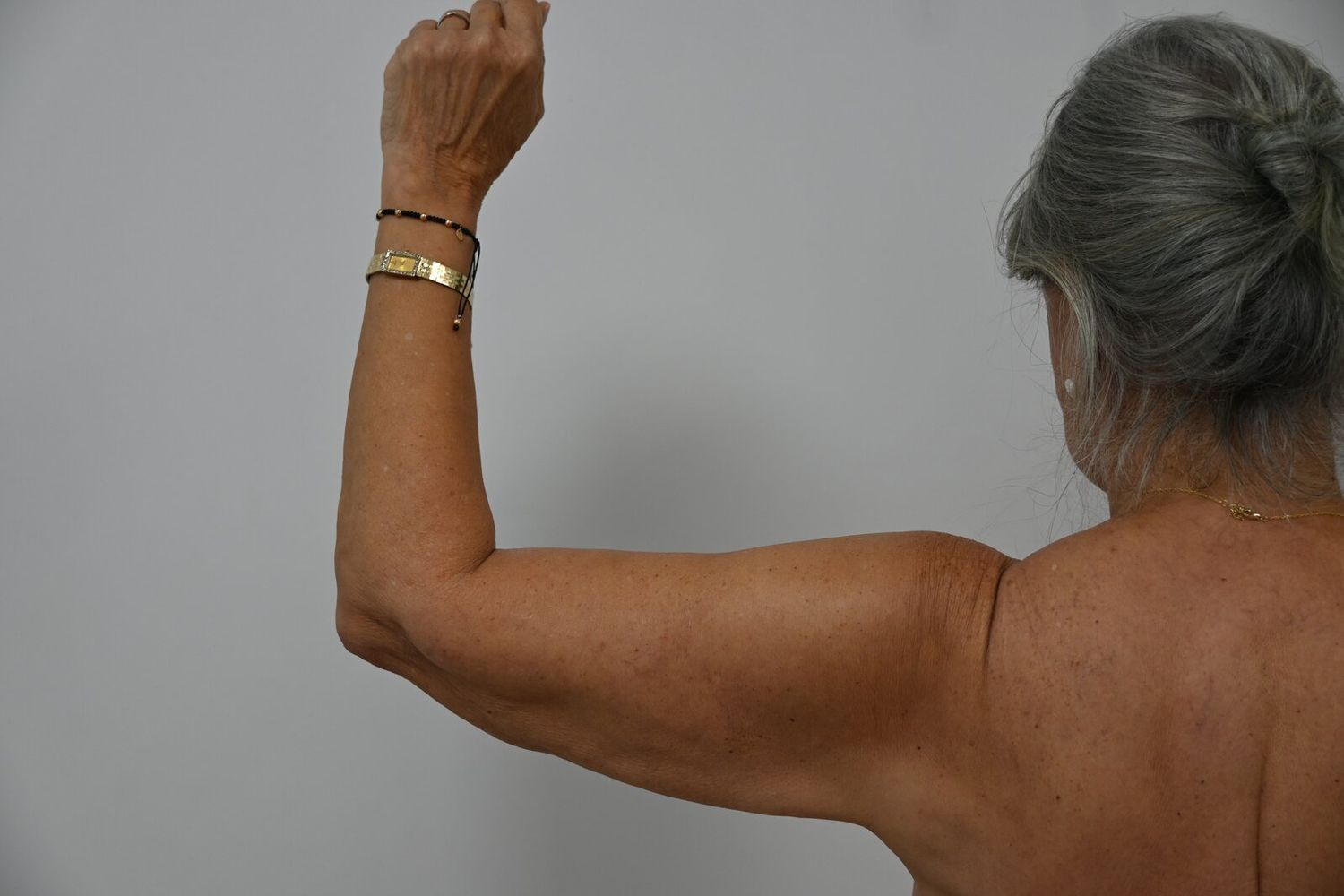 Liposuccion Brazos Before & After