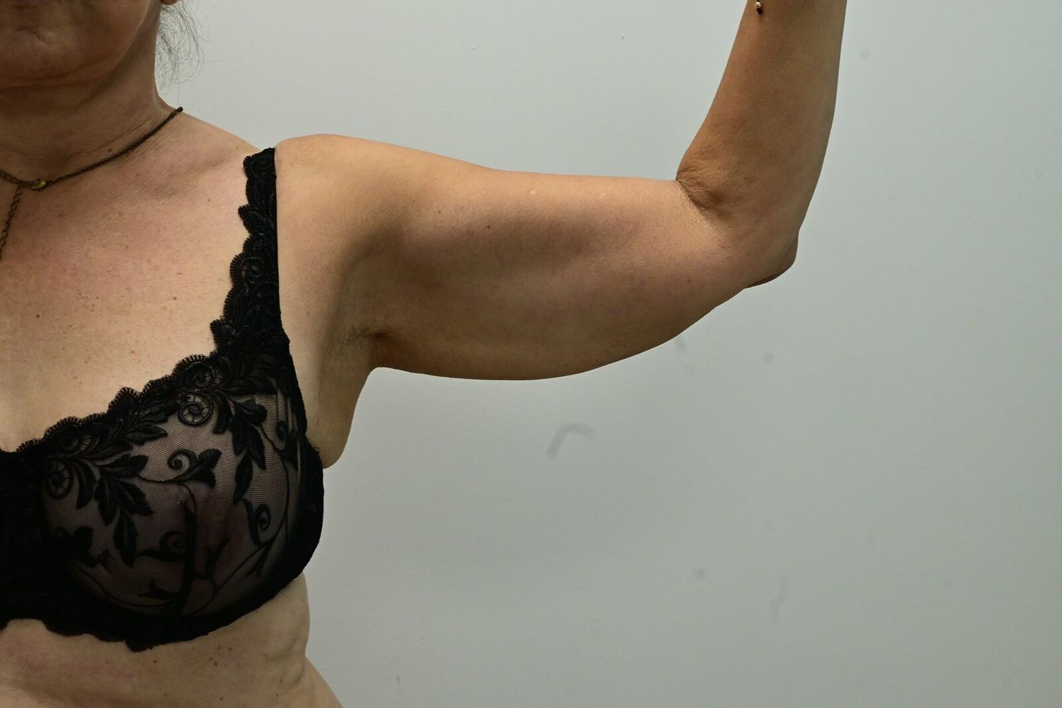 Liposuccion Brazos Before & After