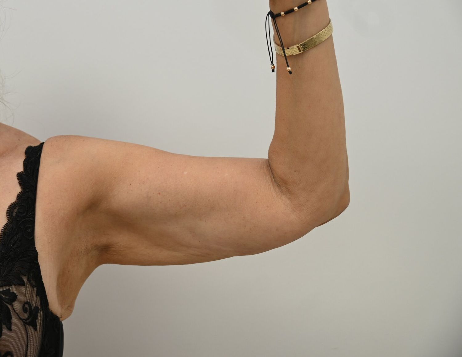 Liposuccion Brazos Before & After