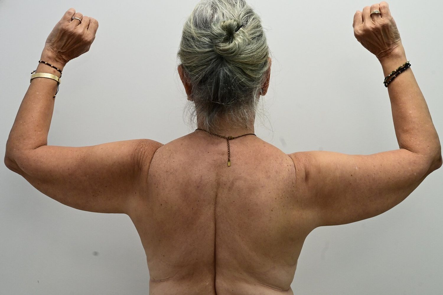 Liposuccion Brazos Before & After