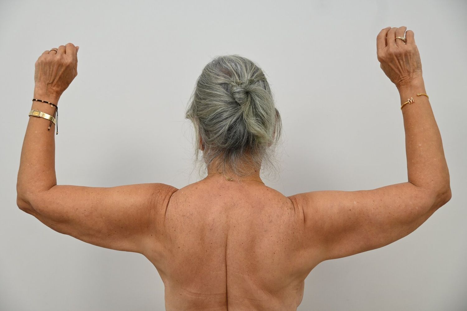 Liposuccion Brazos Before & After