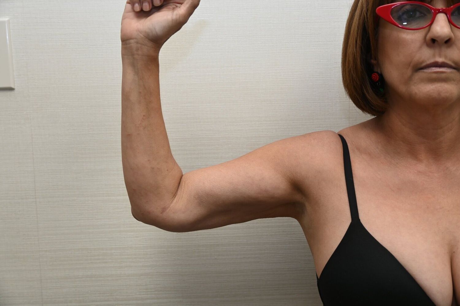 Liposuccion Brazos Before & After