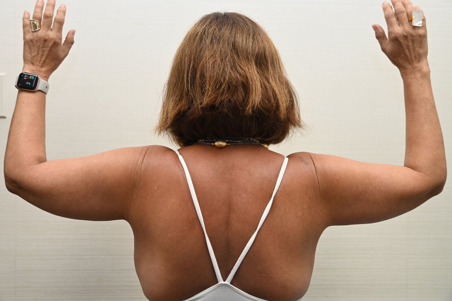 Liposuccion Brazos Before & After