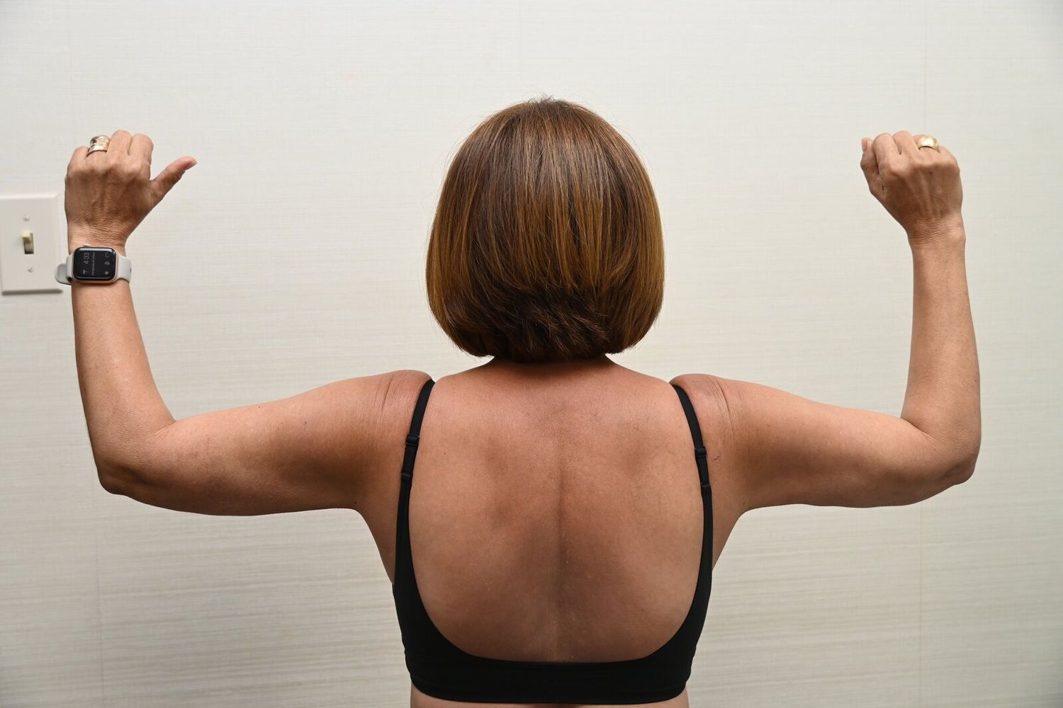 Liposuccion Brazos Before & After