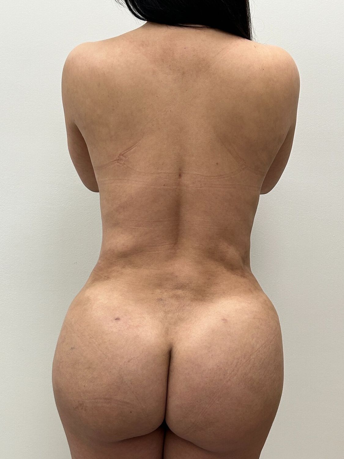 Aumento Gluteos Bbl Before & After