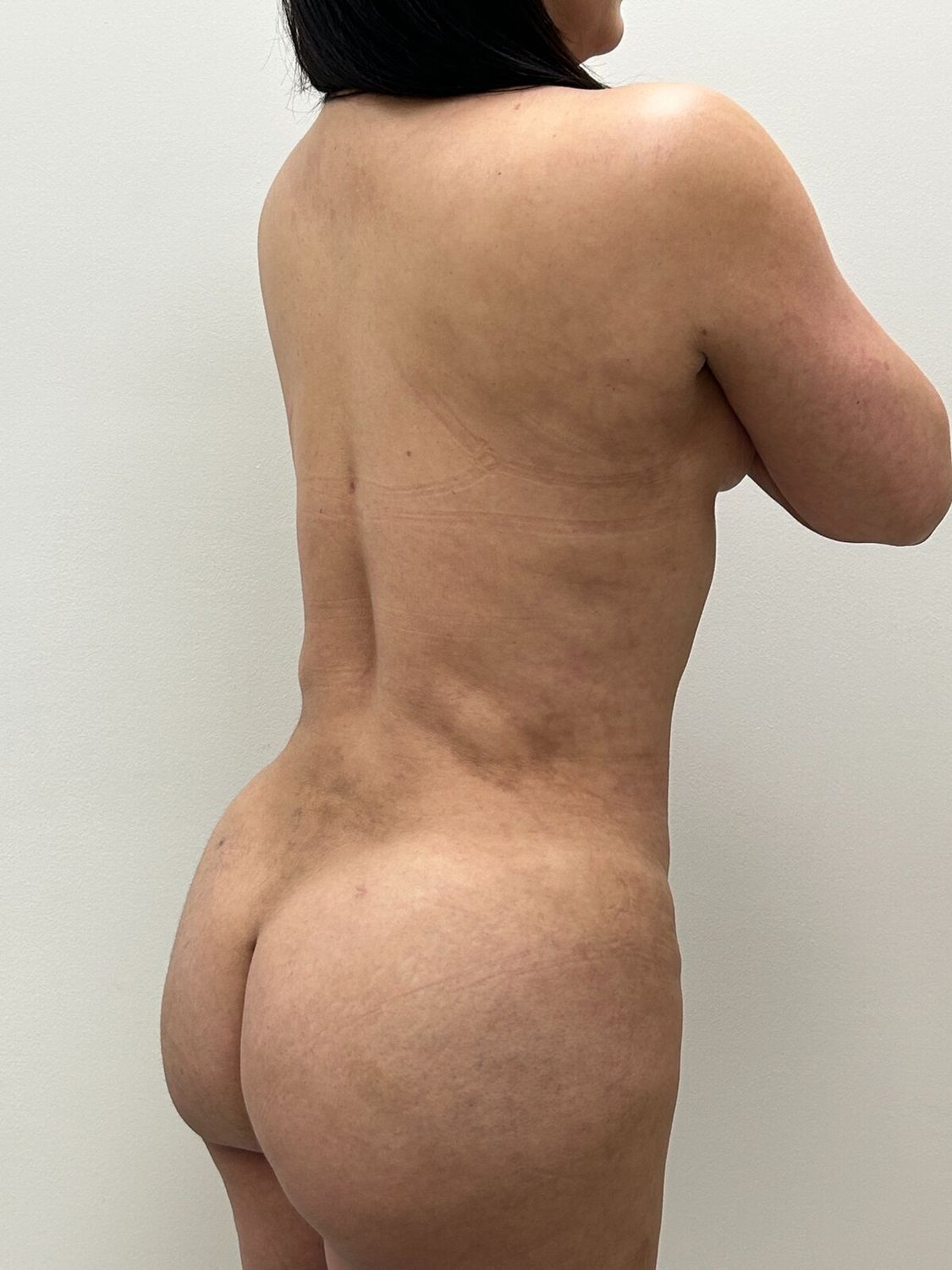 Aumento Gluteos Bbl Before & After