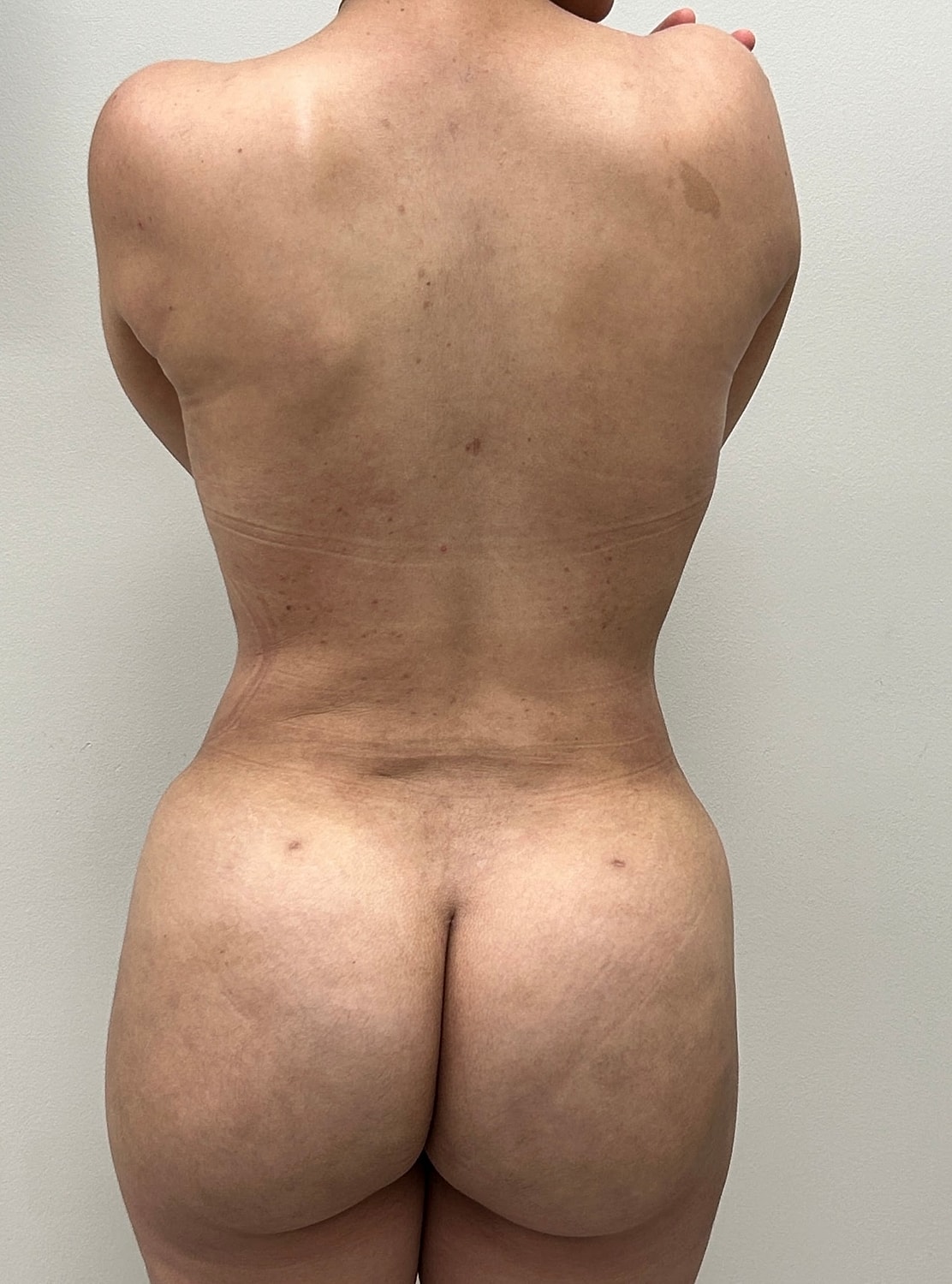 Aumento Gluteos BBL Before & After